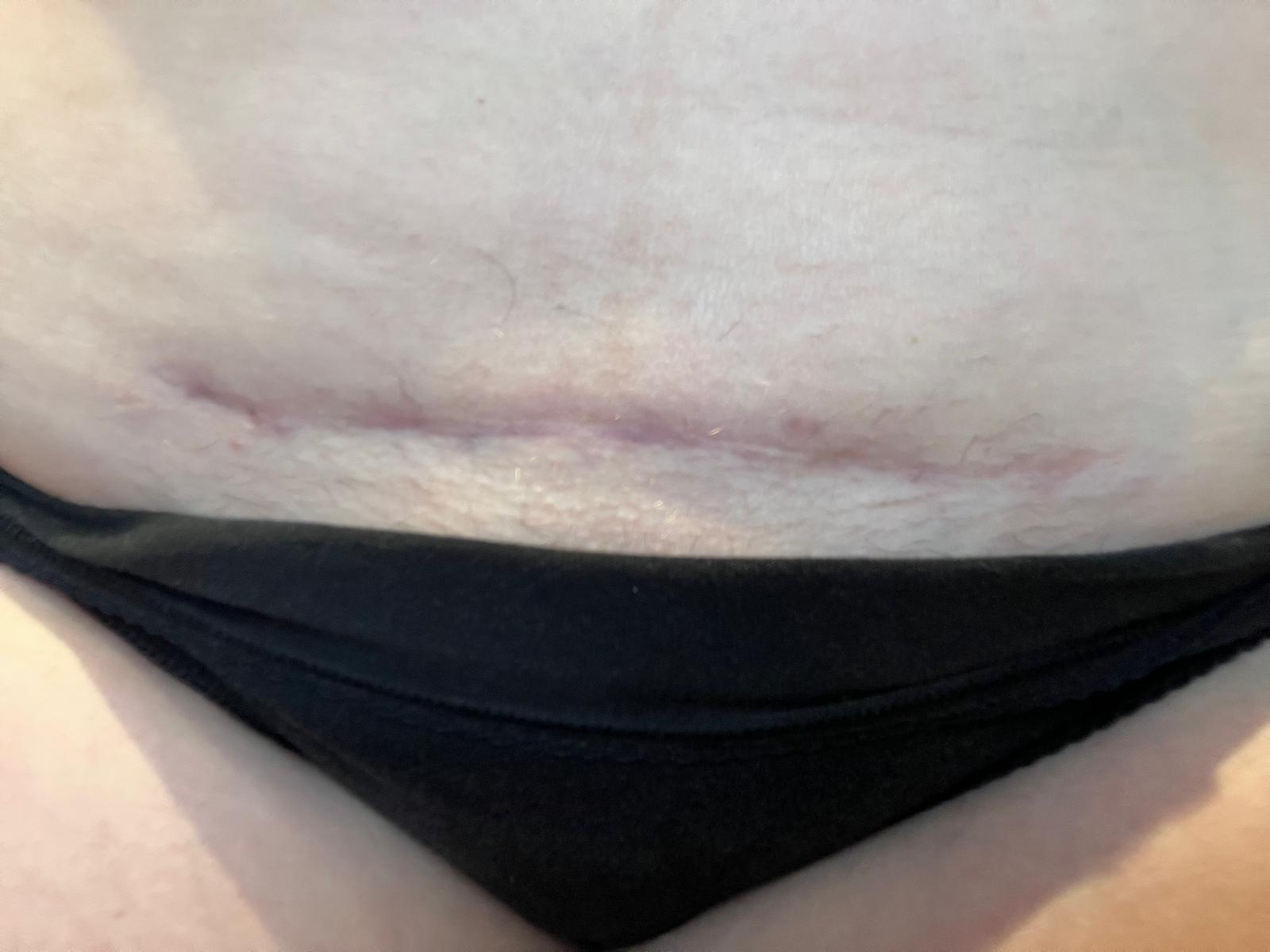 image of c section scar after healing has taken place