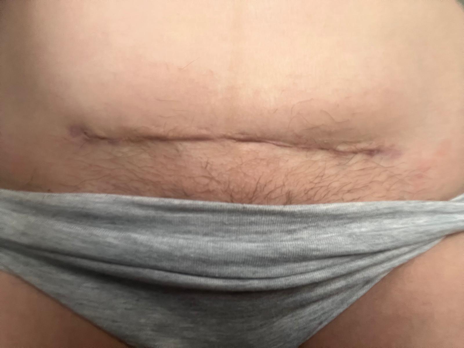 Close-up of a person's abdomen with a visible surgical c section scar, wearing a gray underwear.