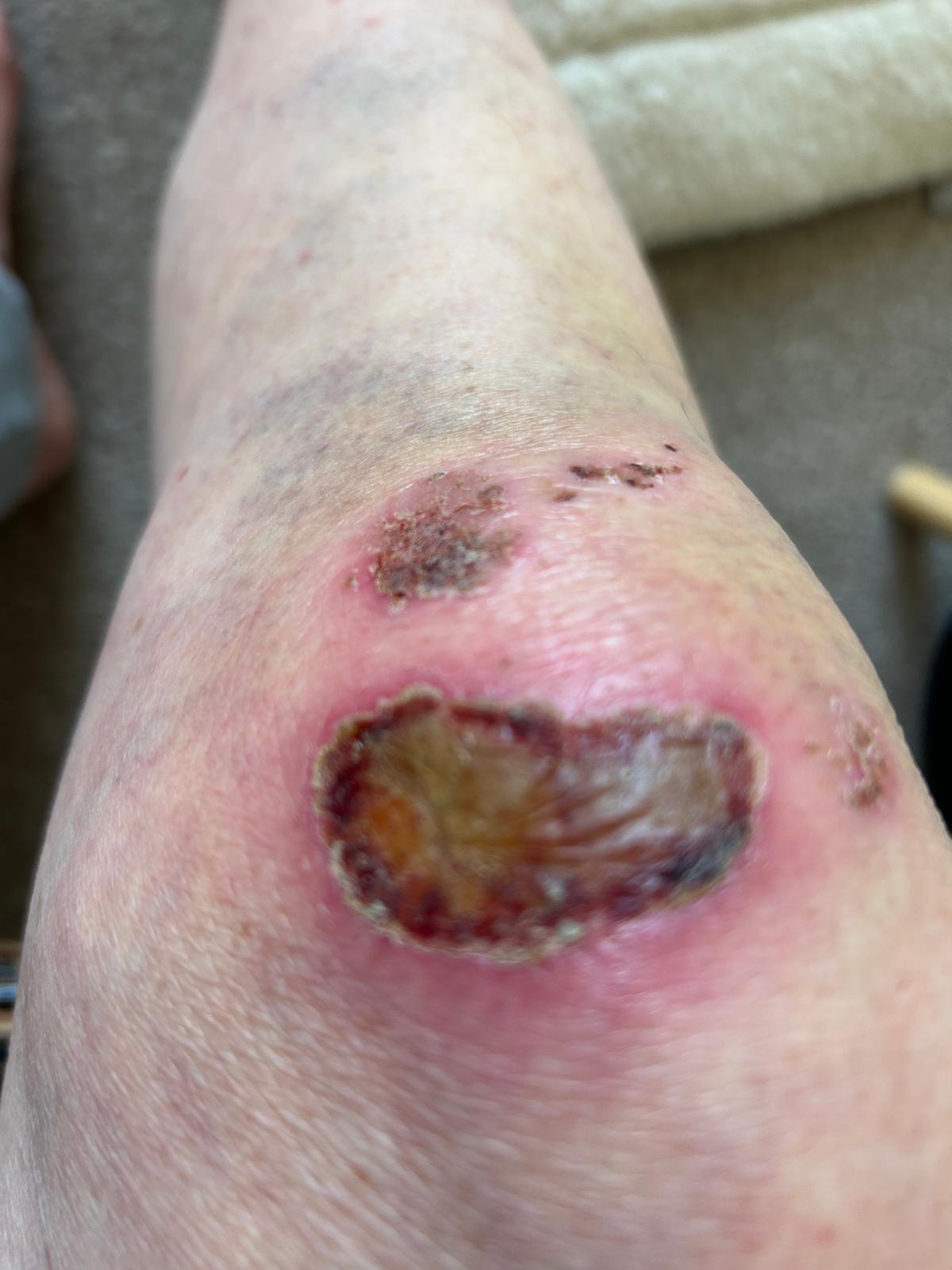 Wound on a person's knee with a large scab and bruising.