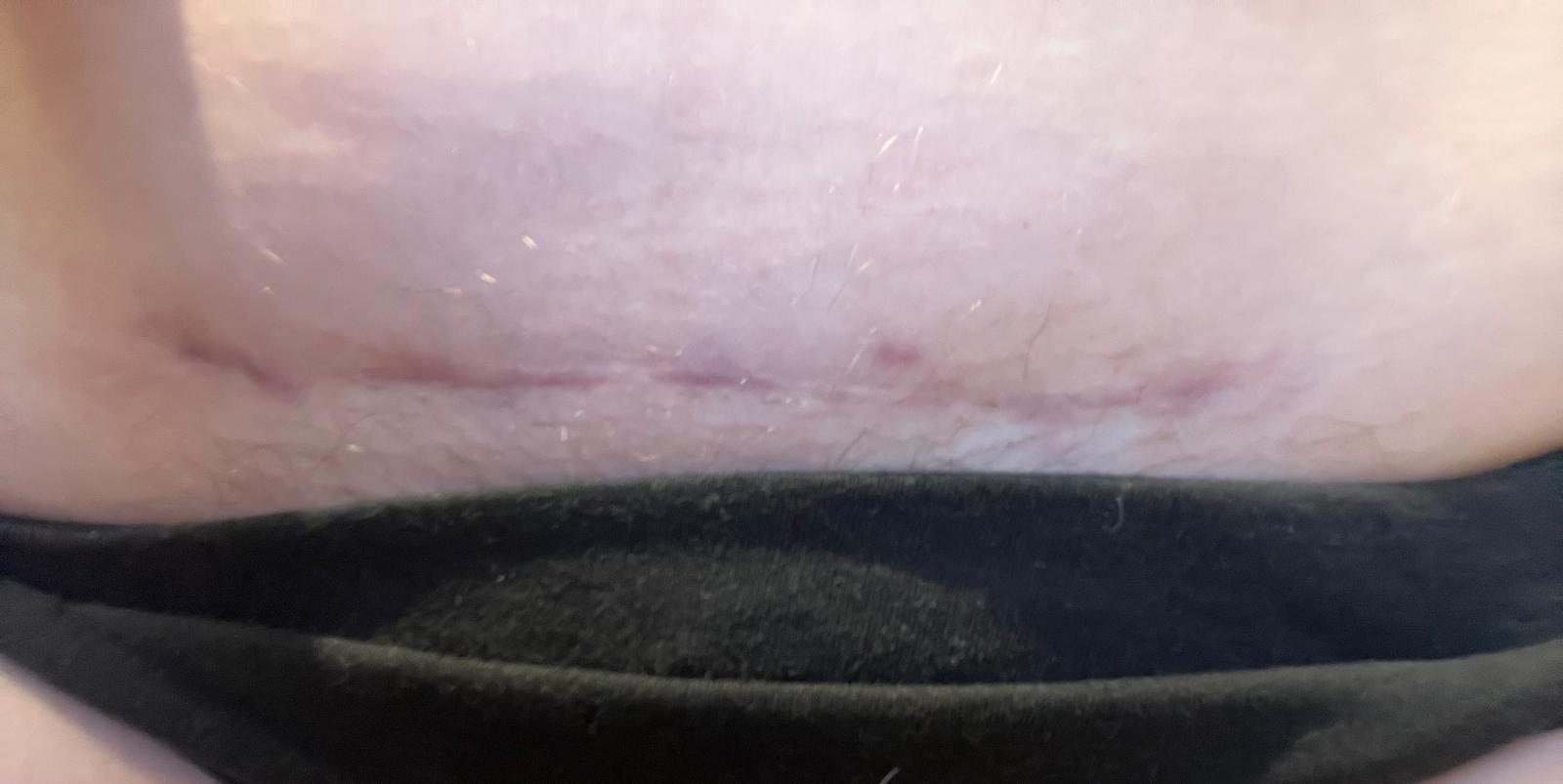 Close-up of a person's abdomen showing healed c section scar  