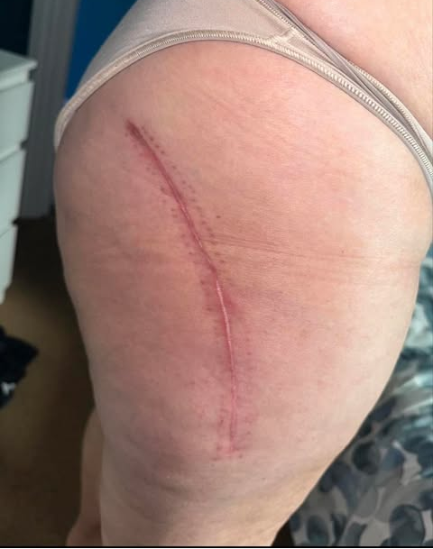 New surgical Scar on a persons leg showing hip surgery